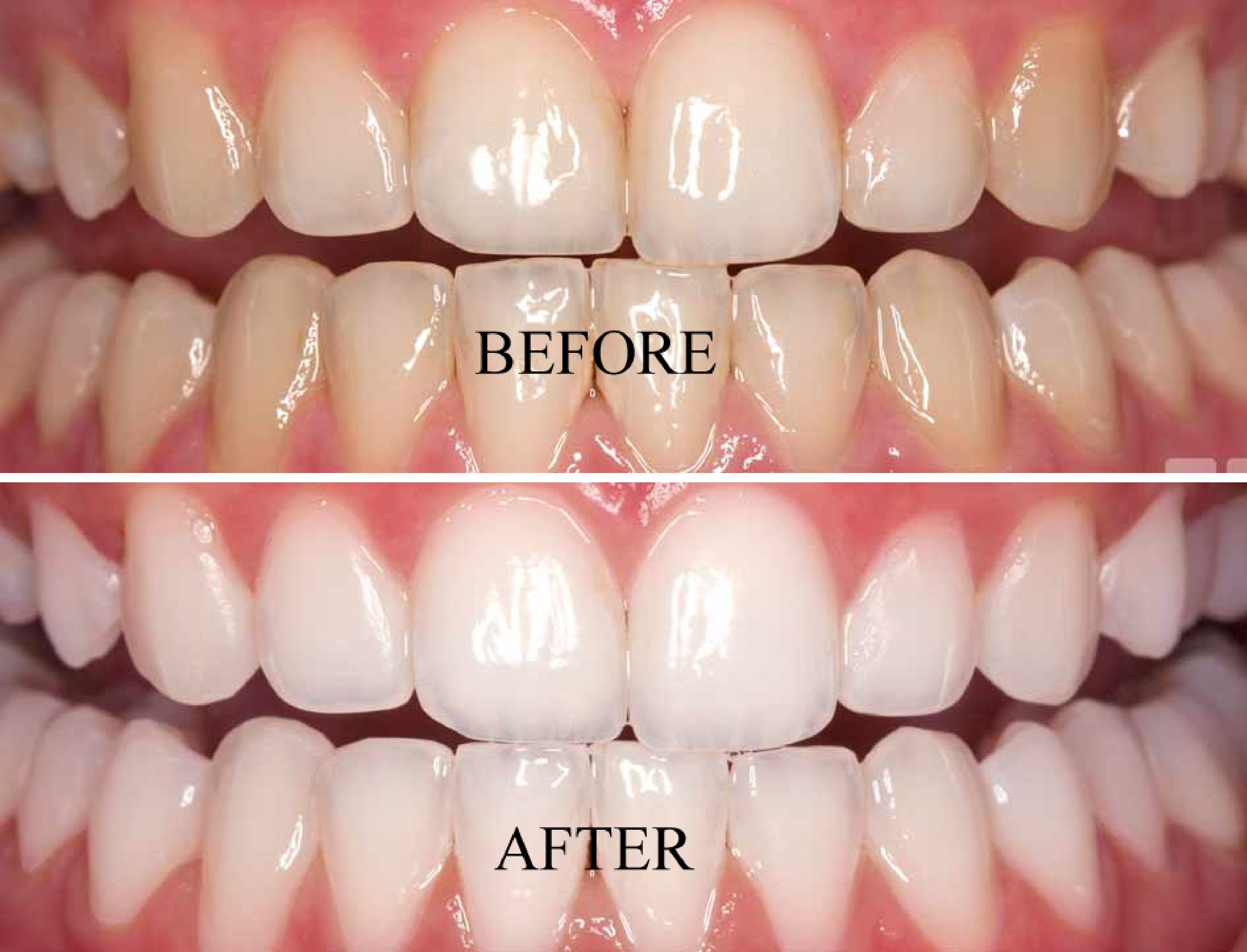 Teeth Whitening in Secunderabad