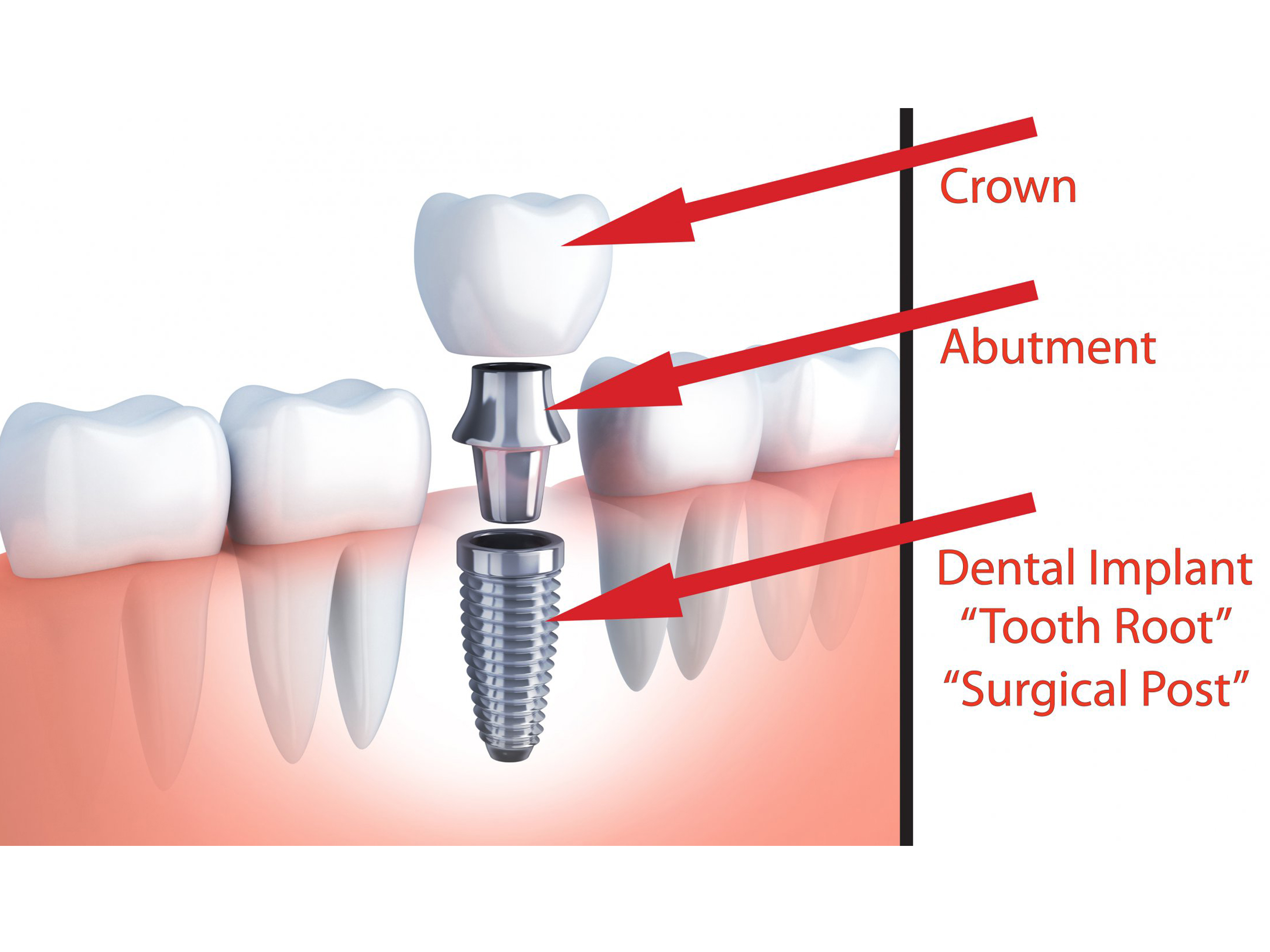 Best Dental Implant Clinic in Secunderabad