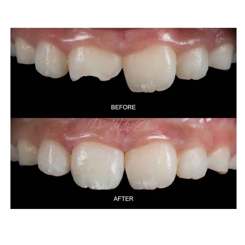 Cosmetic Dental Fillings in West Marredpally