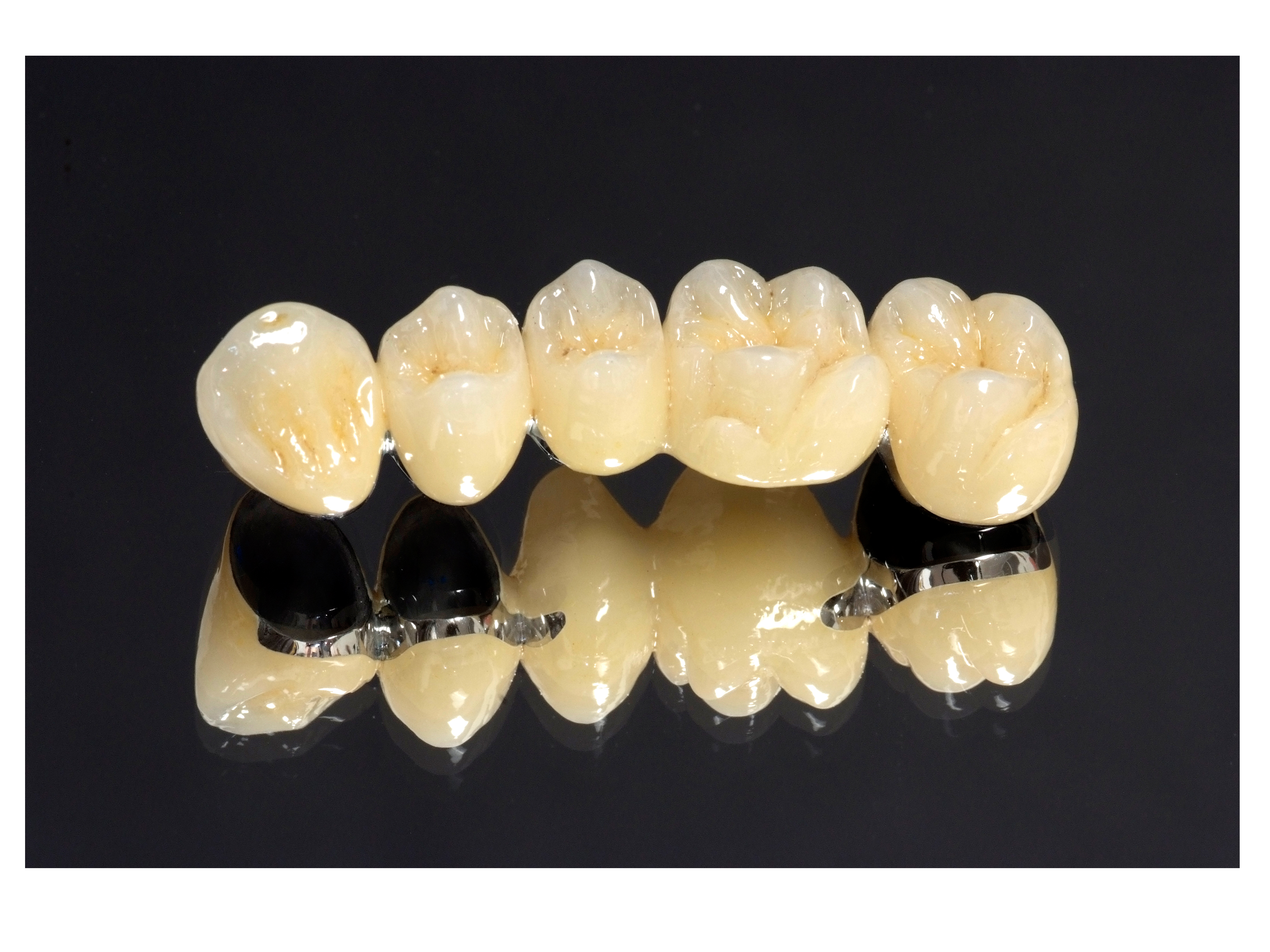 Dental Crowns and Bridges in Secunderabad