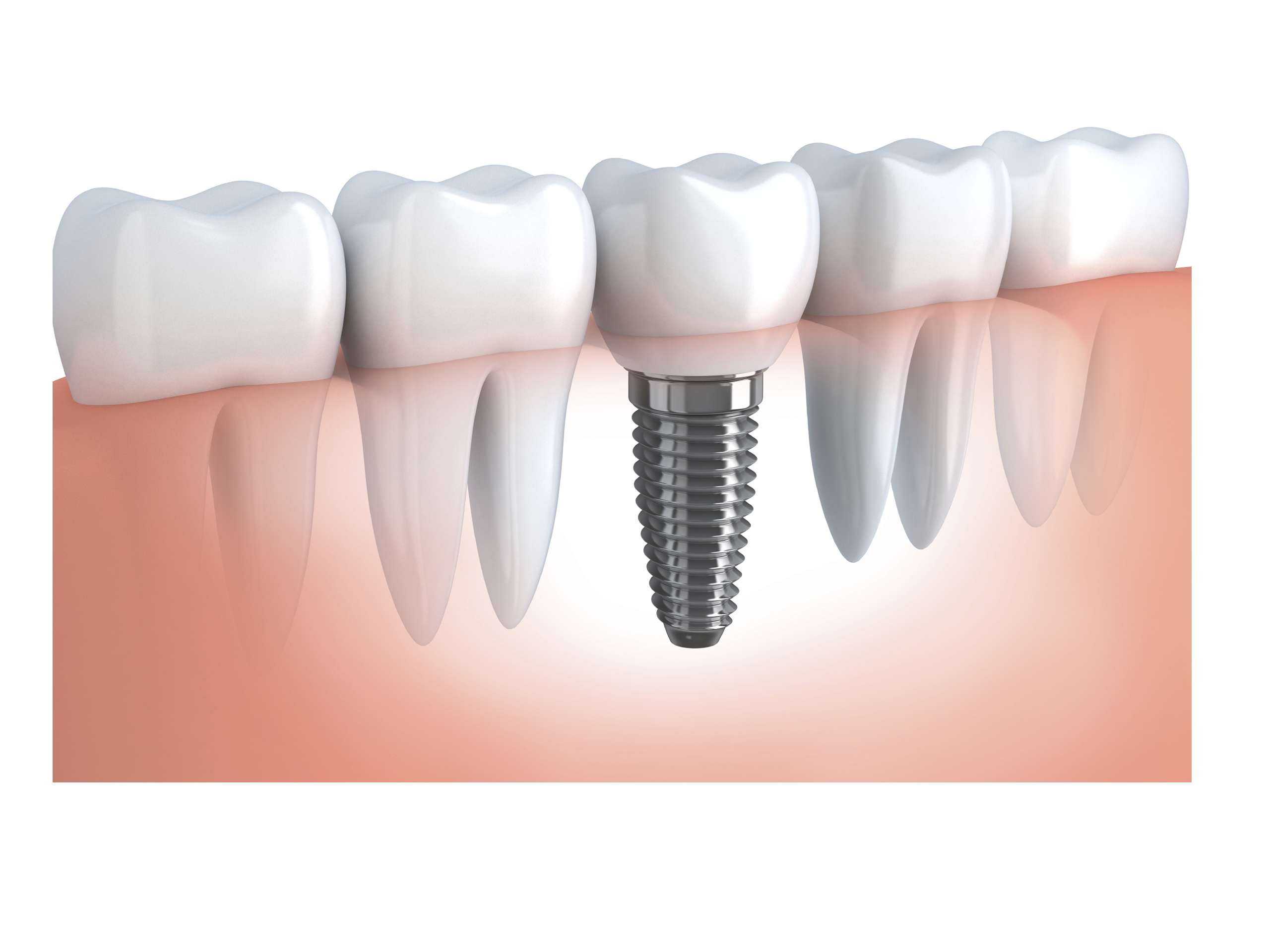 Best Dental Implant Clinic in Secunderabad