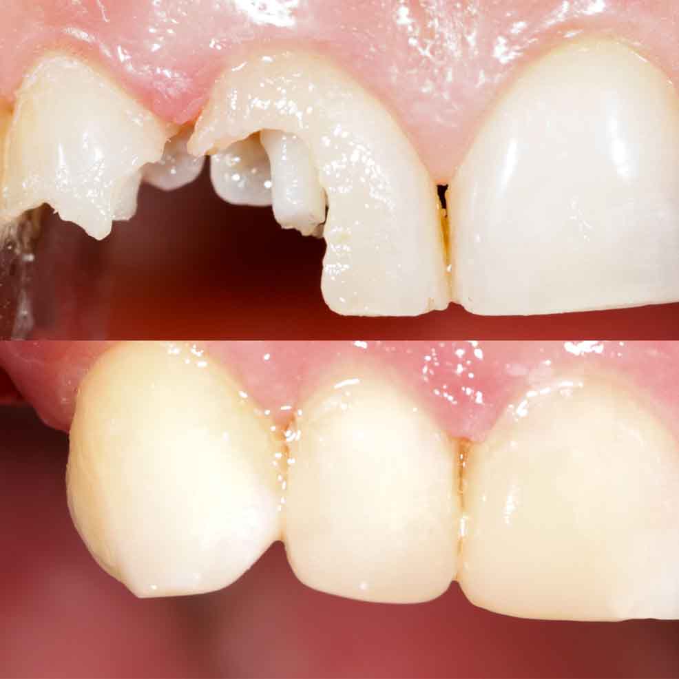 Cosmetic Dental Fillings in West Marredpally