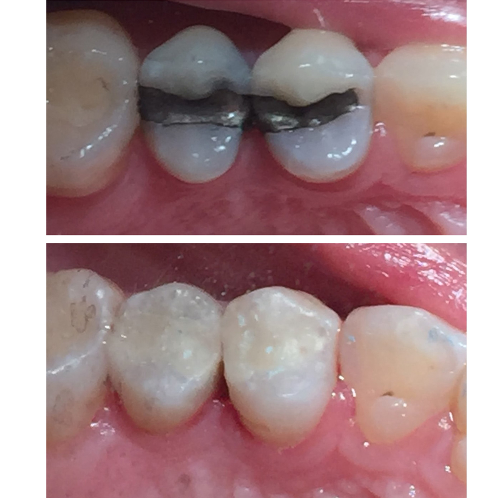 Cosmetic Dental Fillings in West Marredpally