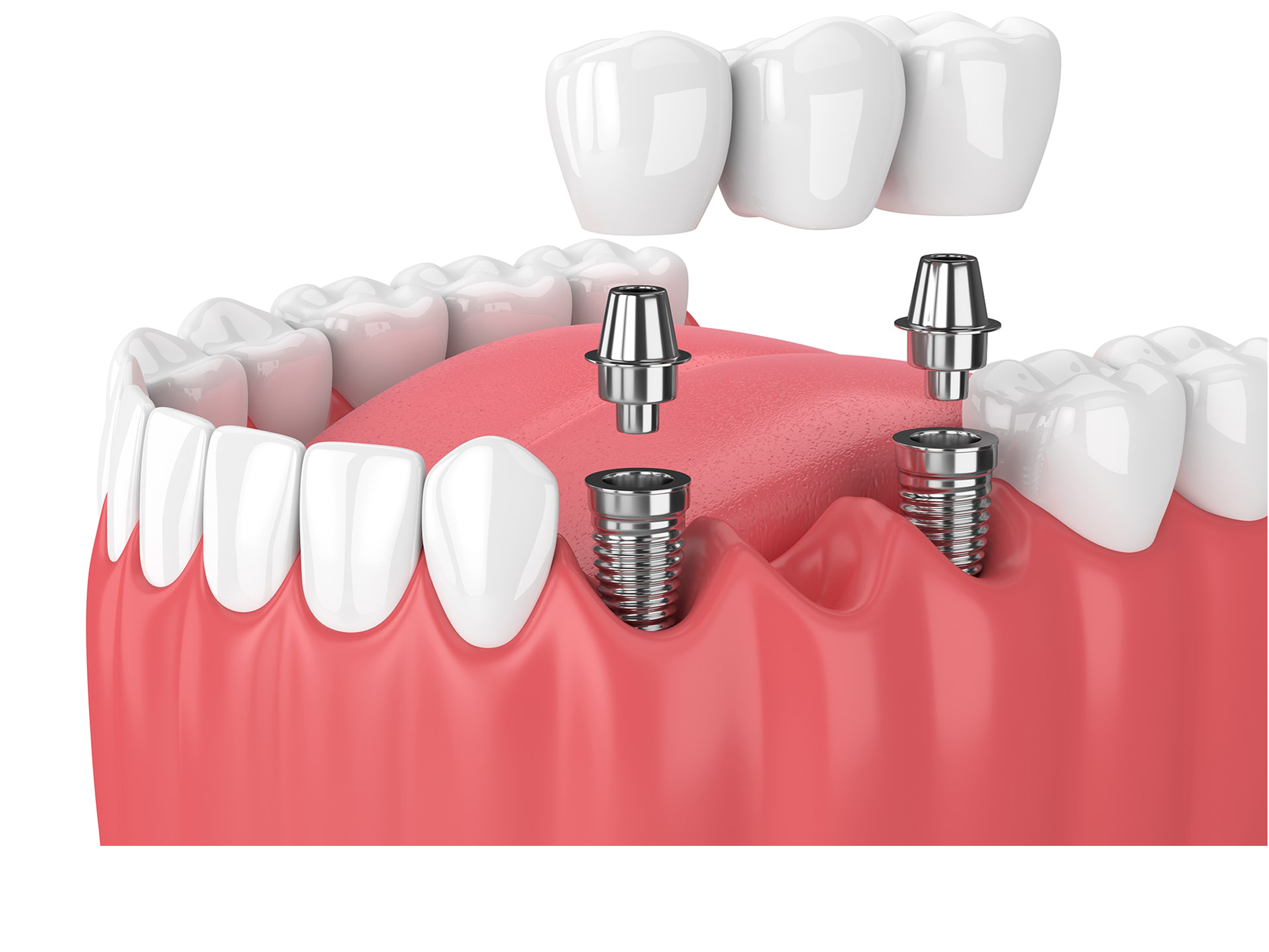 Best Dental Implant Clinic in Secunderabad
