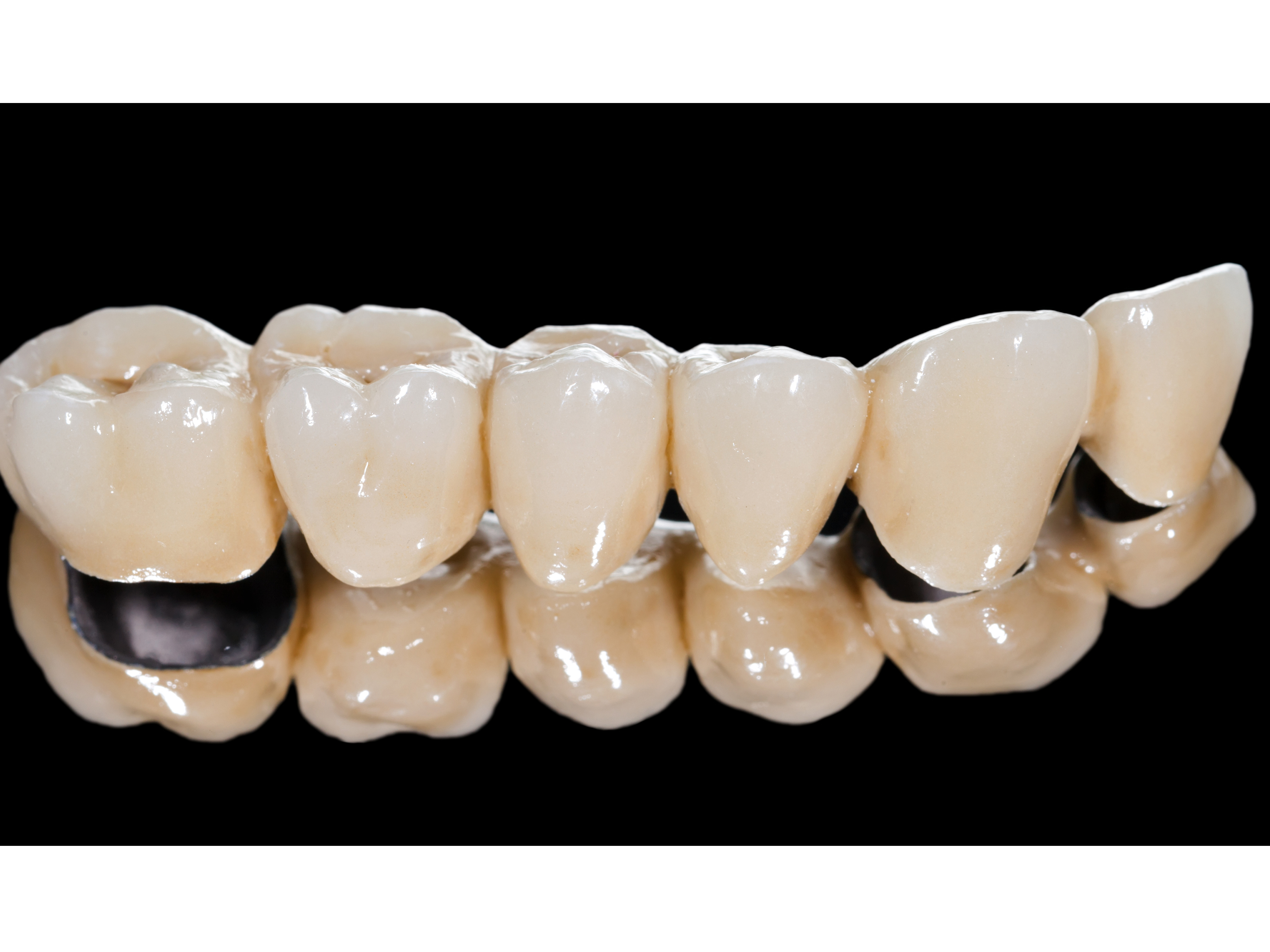 Dental Crowns and Bridges in Secunderabad