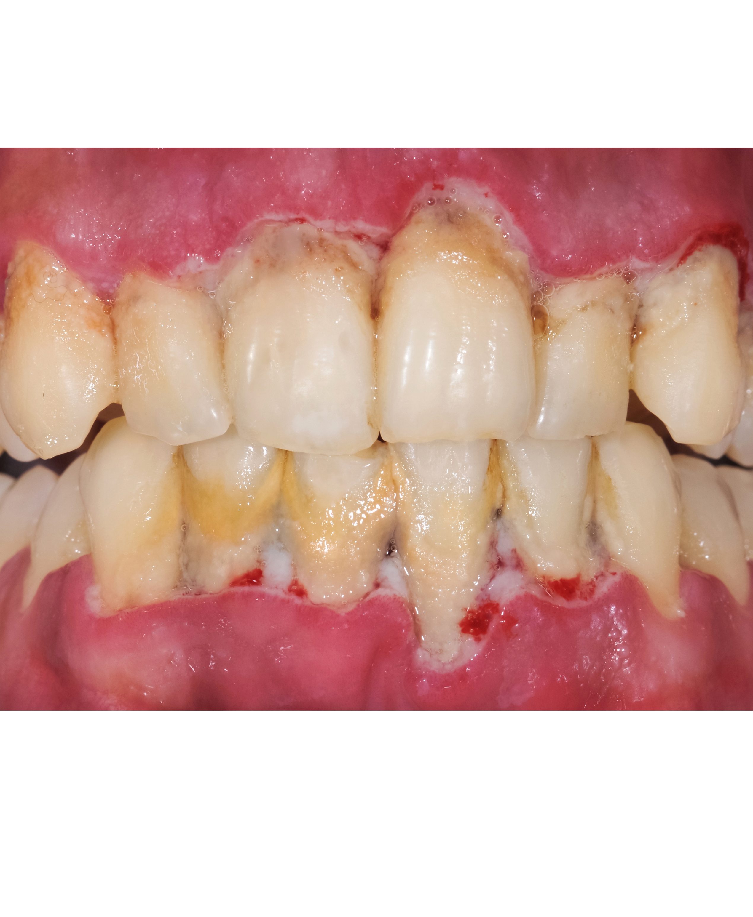 Gum Disease Treatment in Secunderabad