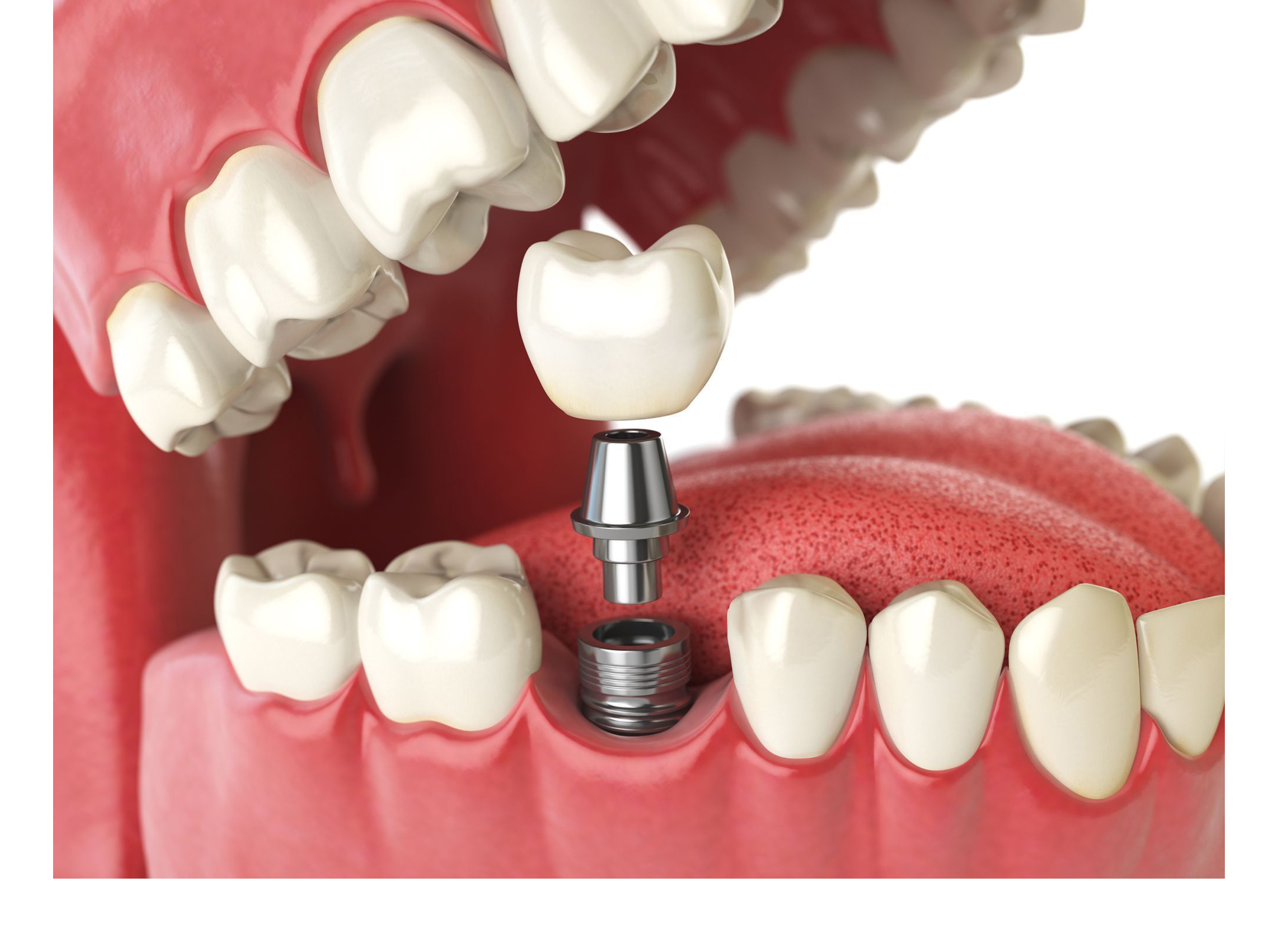 Best Dental Implant Clinic in Secunderabad