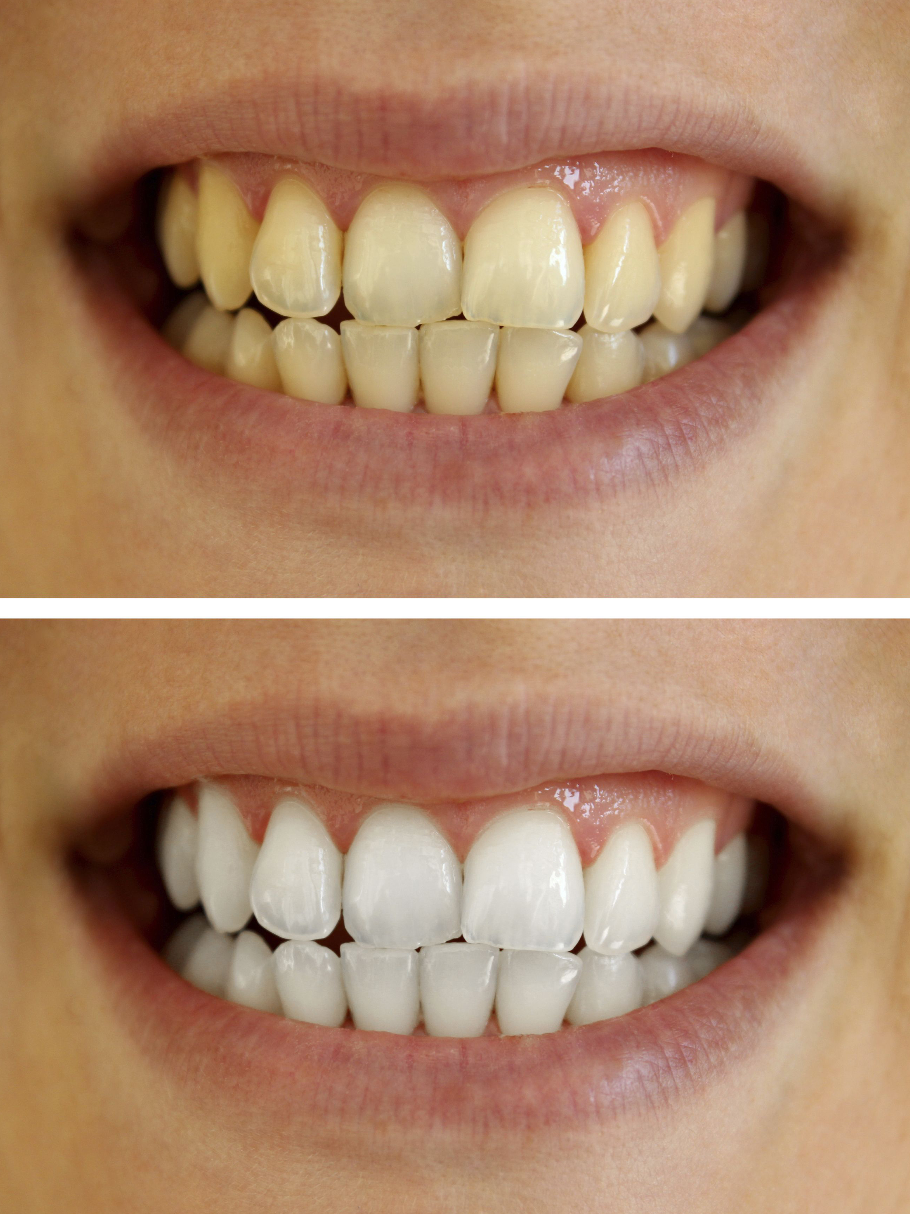 Teeth Whitening in Secunderabad