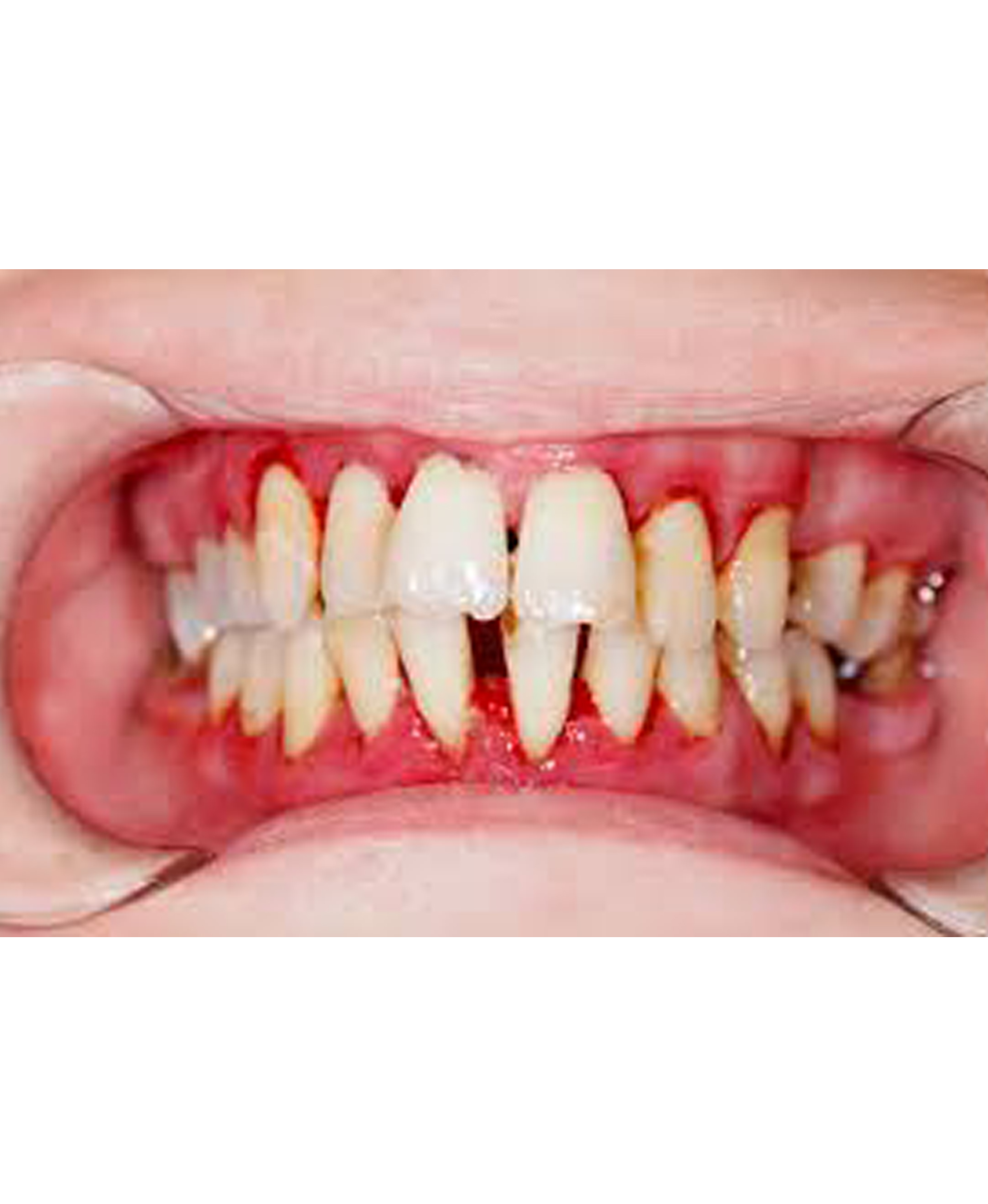 Gum Disease Treatment in Secunderabad