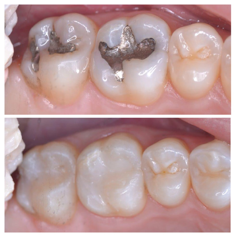 Cosmetic Dental Fillings in West Marredpally