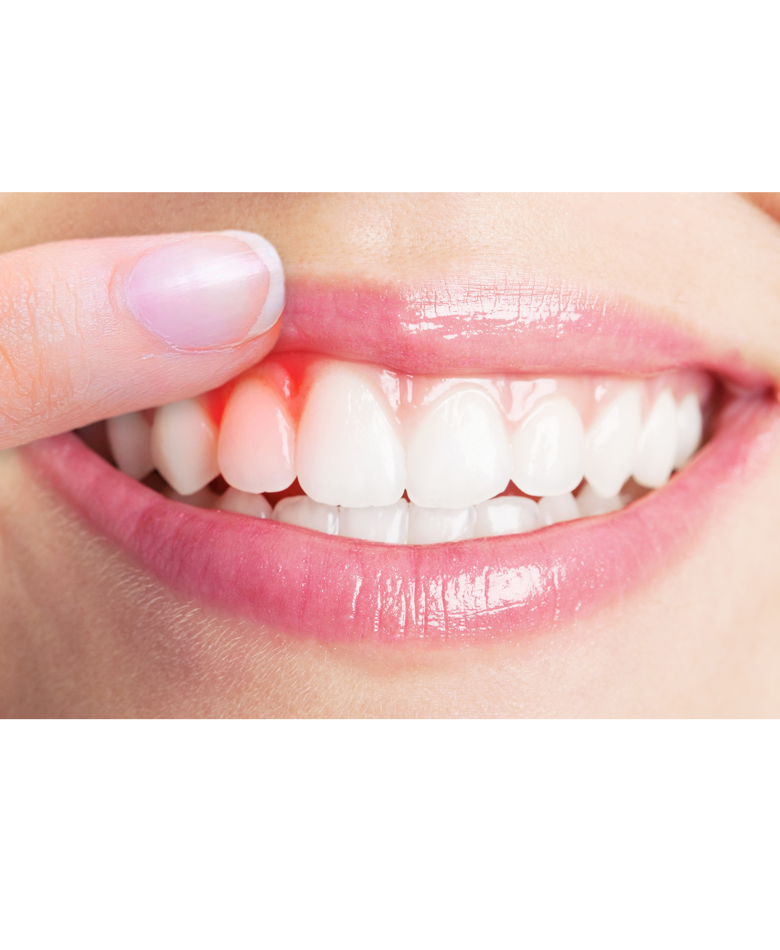 Gum Disease Treatment in Secunderabad