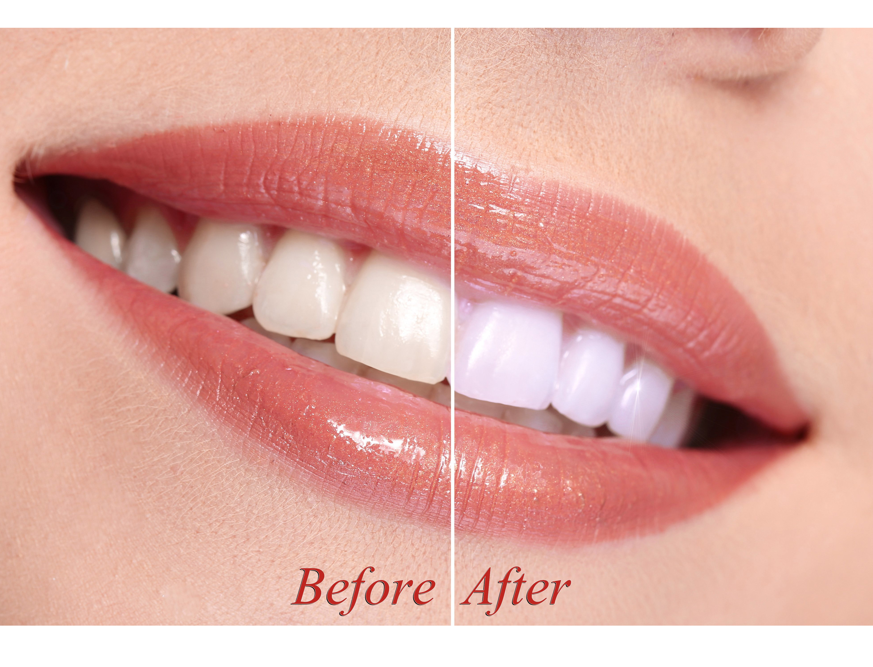 Teeth Whitening in Secunderabad