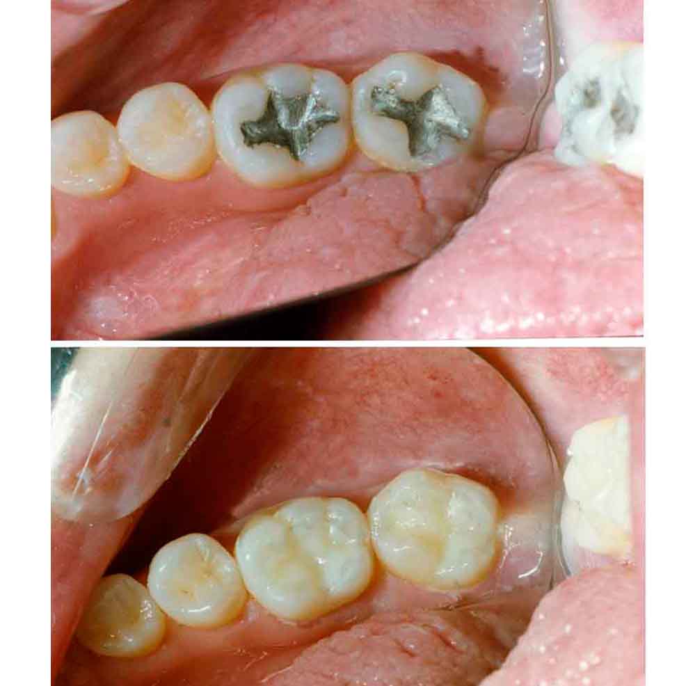 Cosmetic Dental Fillings in West Marredpally